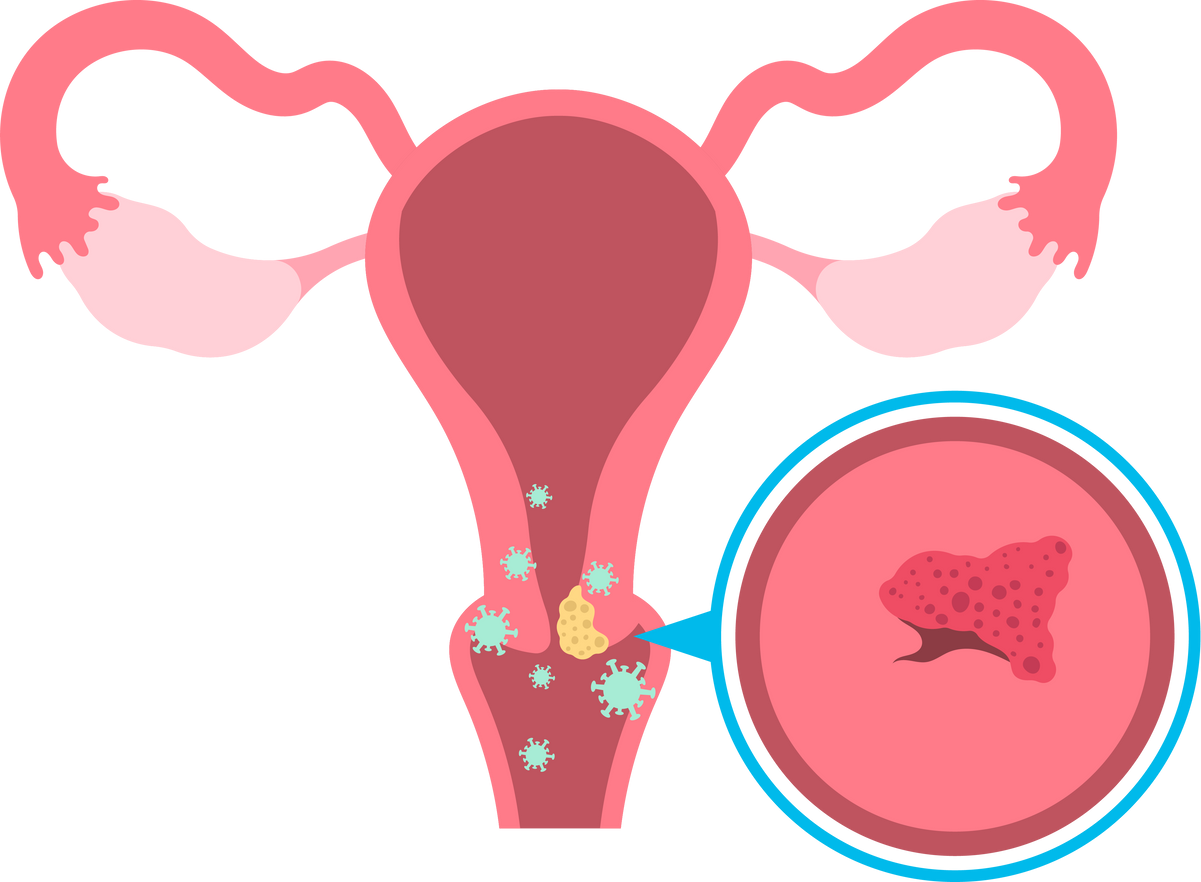 vaginal exam examine cell herpes dysplasia women female test